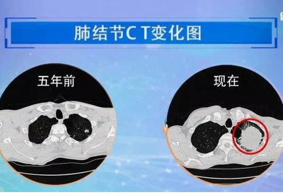 肺結節CT變化.png