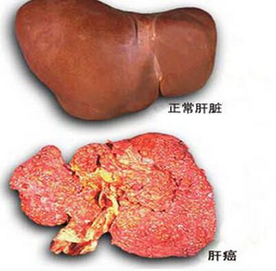 肝對比.jpeg